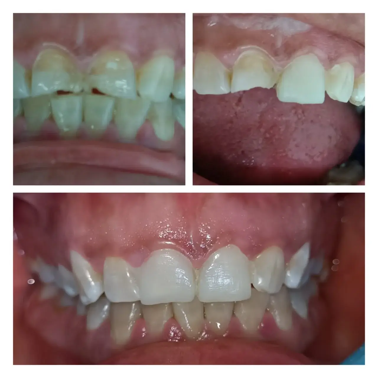 Blanqueamiento dental